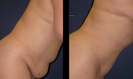 image-807150-abdomen_before_after.jpg